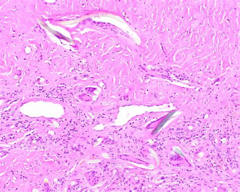 Pilonidal Cyst