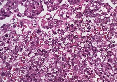 Pathology Outlines Clear Cell Carcinoma