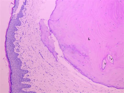 Photomicrograph of osteoma within the skin of external auditory canal ...