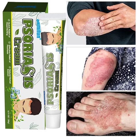 Crema Para Psoriasis Tratamiento Para Dermatitis Eczematoid Pomada Para