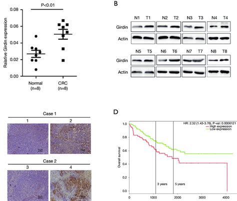 Girdin Is Upregulated In Crc And Has A Poor Prognosis Of Crc Patients