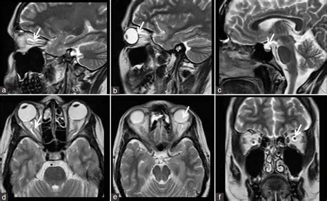 Head Pseudotumor Cerebri | Health Care and Lifestyle