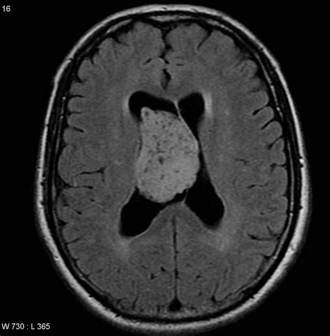 Choroid Plexus Papilloma Radiology Reference Article Radiopaedia