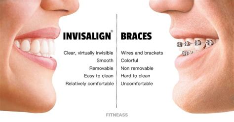 7 Things You Should Consider Before Getting Invisalign Braces Fitneass