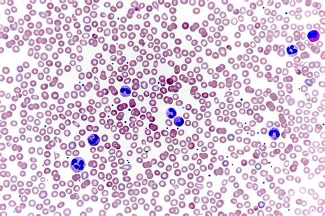 Pathology Outlines Reactive Neutrophilia