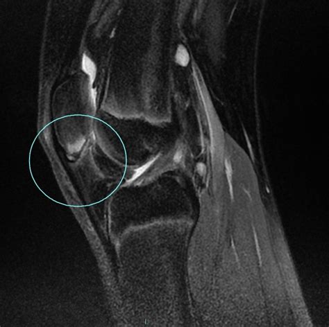 Sinding Larson Johansson Slj Syndrome And Distal Femoral Cortical