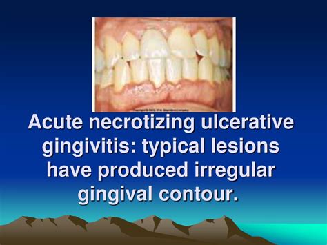 Ppt Necrotizing Ulcerative Gingivitis Powerpoint Presentation Free