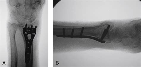 Open Reduction And Internal Fixation Of The Distal Radius With A Volar