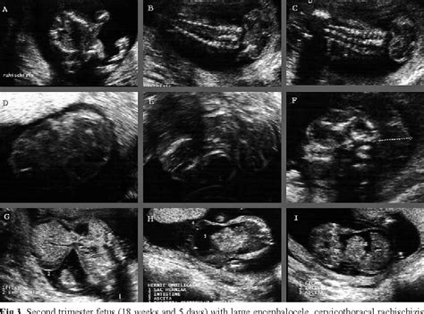 Figure 8 From Prenatal Ultrasound Diagnosis Of Neural Tube Defects