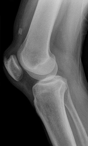 Quadriceps Tendon Tear Physiopedia