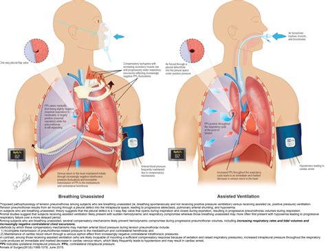 Pneumothorax In Emergency Department Recapem