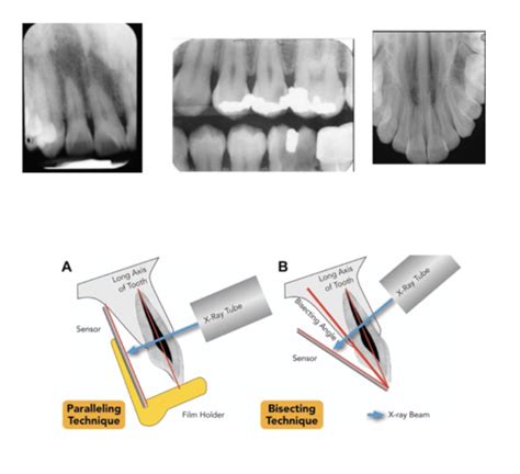 6 Intraoral Radiographic Procedures Flashcards Quizlet