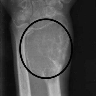 X Ray Of Wrist Joint Showing Gctb In The Lower End Of Radius Image