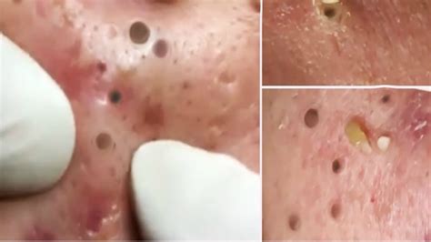 Satisfying Doctor Pimple Blackhead Removal Youtube