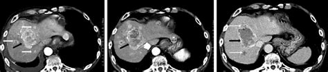 The Serial Plain Abdominal And Pelvic Ct Images A An Arterial Phase Of