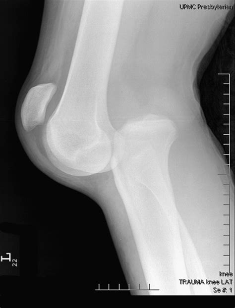 Management Of The Acute Knee Dislocation The Pittsburgh Experience