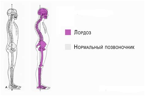 Лордоз что это виды причины