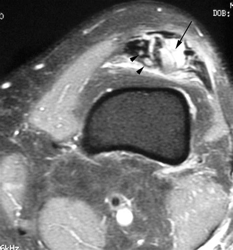 Calcific Tendonitis Of The Quadriceps British Journal Of Sports Medicine