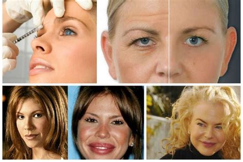 Mitos Y Realidades Del Botox EL ESPECTADOR