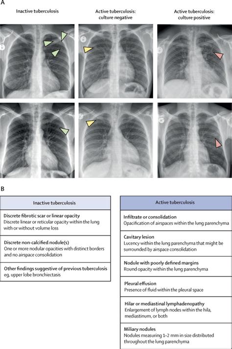 Tuberculosis Notes Diagrams Illustrations Osmosis Off