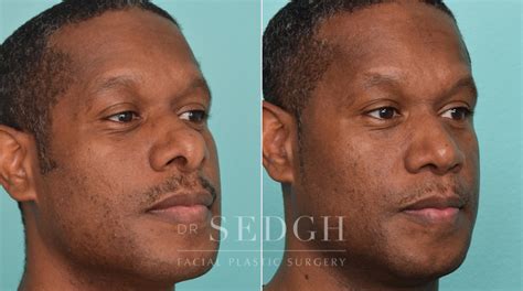 Male Rhinoplasty Before And After Photos Dr Sedgh