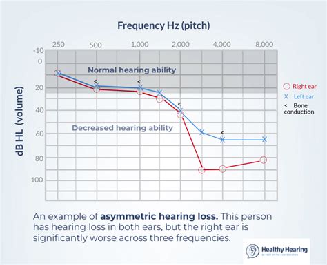 Normal Audiogram