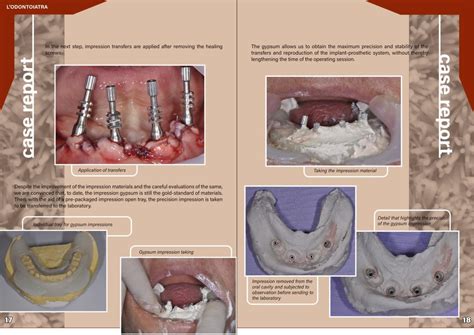 Complete Rehabilitation With Total Upper Prosthesis And Lower Full Arch