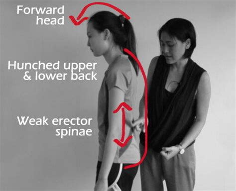 Flat back Posture - a leading poor posture type causing back pain