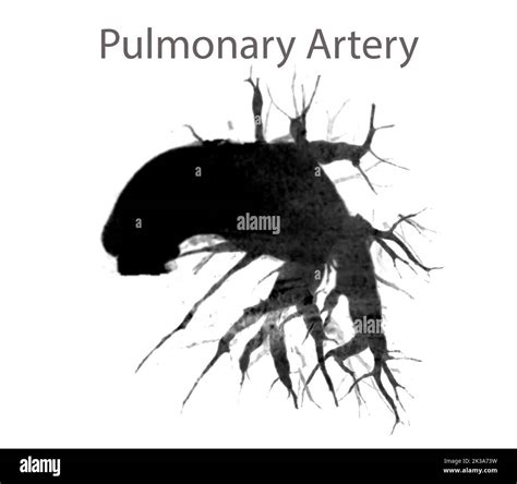 Cta Pulmonary Arteries Showing Branch Of Pulmonary Artery Stock Photo