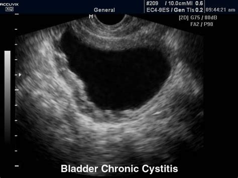 Ultrasound images • Bladder - chronic cystitis, B-mode, echogramm №373