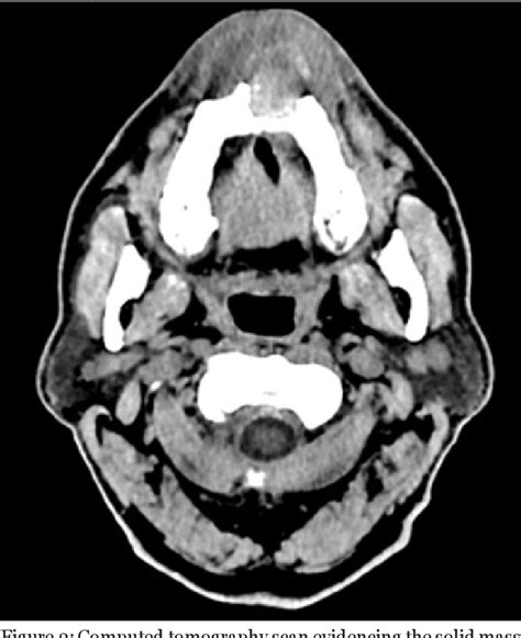 Figure 2 From Metastatic Rectal Adenocarcinoma In The Maxillary Bone A Case Report Semantic