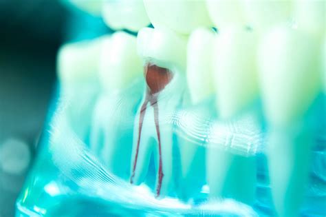 Benefits Of Root Canal Therapy East Lansing Modern Dental