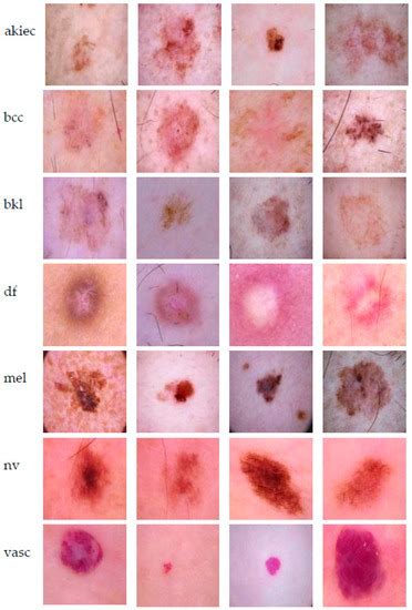 Sensors Free Full Text Skin Lesion Classification Using Collective