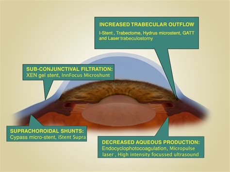 Escrs Cataract And Migs