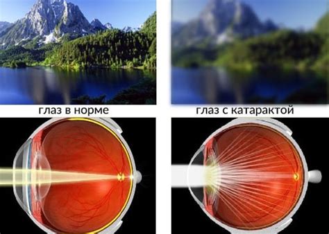 Что такое катаракта: виды, причины, симптомы, лечение - MOSCOWEYES.RU ...