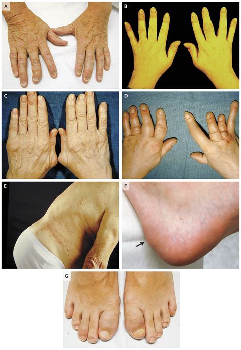 Psoriatic Arthritis | NEJM