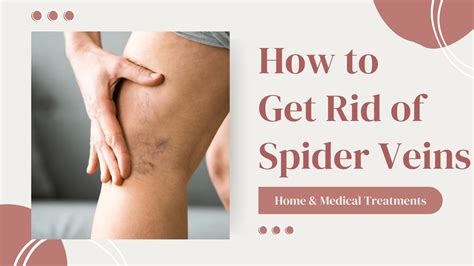 How To Get Rid Of Spider Veins Gilvydis Vein Clinic