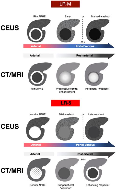 Diagnosing Non Hepatocellular Carcinoma Malignancies On Ct Mri And