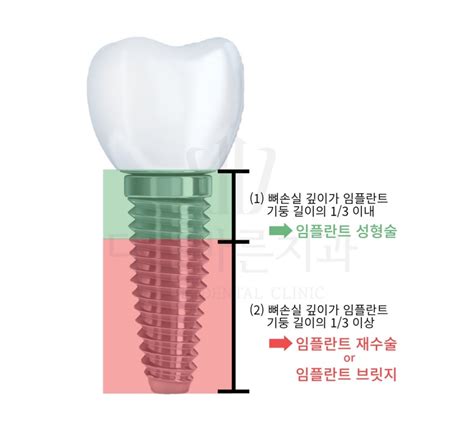 임플란트 주위염 치료하는 3가지 방법 김원장 칼럼