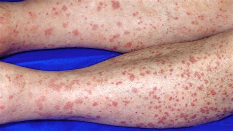 Pictures Of Vasculitis On Skin