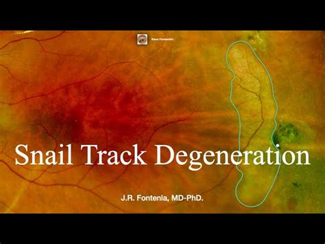 Cystoid Degeneration