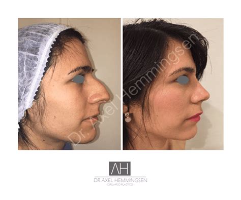 Rinoplastia En Argentina