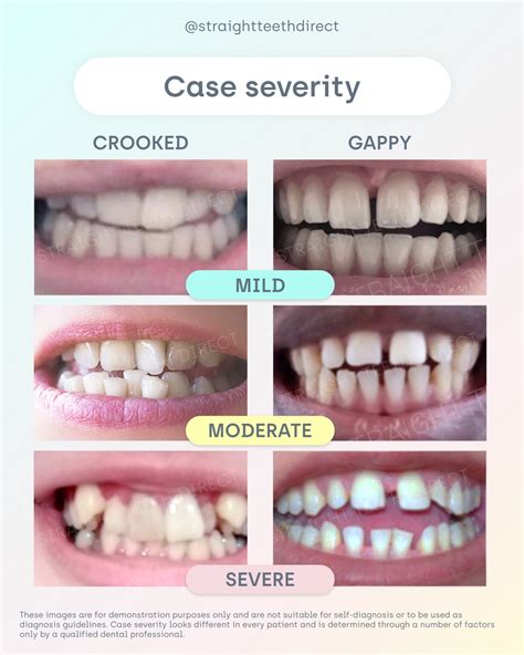 How Long Do Braces Take Vs Straight Teeth Direct Aligners