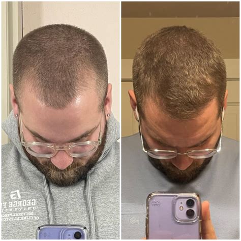 9 Months On Hims Minoxidil And Finasteride Spray Happy With The Results