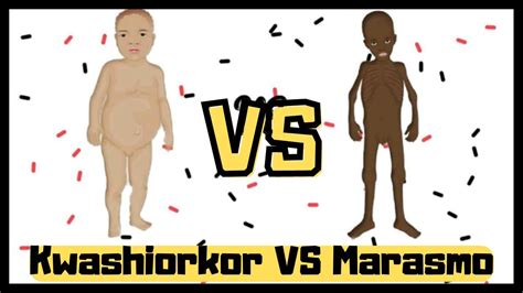 Marasmo Kwashiorkor Diferencias Youtube