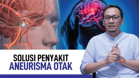 Aneurisma Otak Penyebab Gejala Dan Penanganannya Kata Dokter YouTube