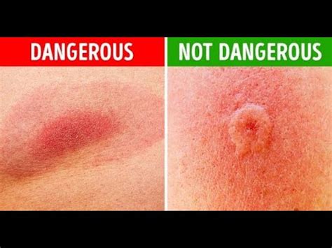 Here Are Common Bug Bites And How You Can Recognize Them