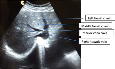 Liver Ultrasound Anatomy