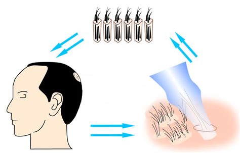 Hair Transplant Recovery Process Estenbul Health