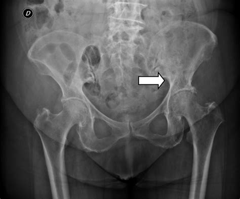 Radiographs Of The Left Hip In Anteroposterior View Showing Hip